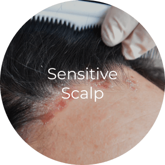Sensitive Scalp