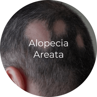 Alopecoa Areata